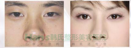 想不到隆鼻后，我的鼻子变得如此高挺秀气(图8)