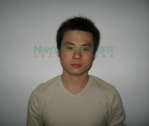 想不到隆鼻后，我的鼻子变得如此高挺秀气(图2)
