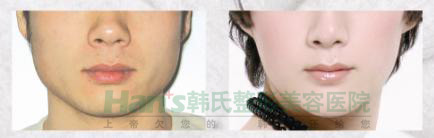 想不到隆鼻后，我的鼻子变得如此高挺秀气(图9)