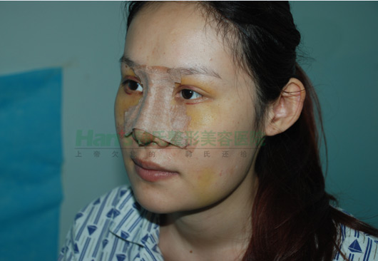 刚做了隆鼻手术，自我感觉非常好(图4)