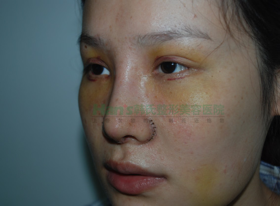 刚做了隆鼻手术，自我感觉非常好(图5)