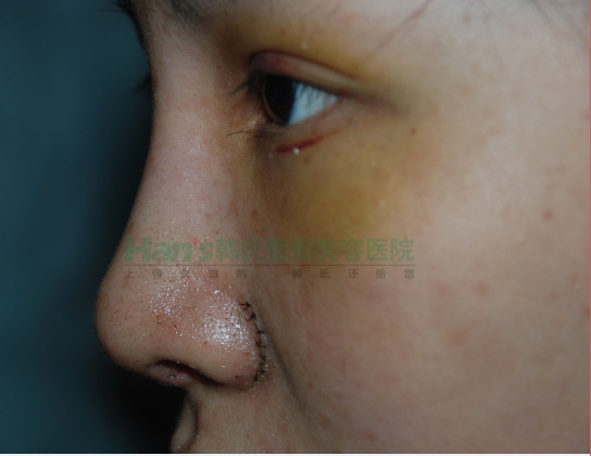 刚做了隆鼻手术，自我感觉非常好(图6)