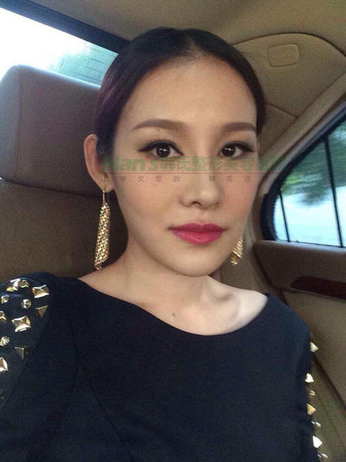 刚做了隆鼻手术，自我感觉非常好(图1)