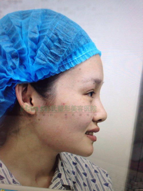 刚做了隆鼻手术，自我感觉非常好(图3)