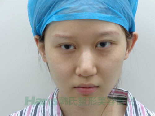 按捺不住内心的小激动，和小伙伴分享一下我的隆鼻记录~(图1)