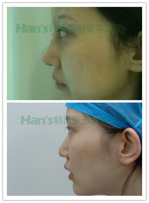 按捺不住内心的小激动，和小伙伴分享一下我的隆鼻记录~(图5)