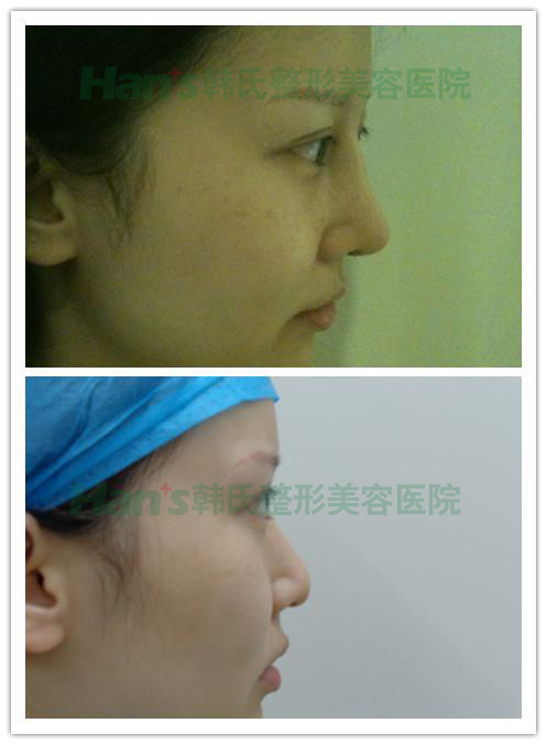 按捺不住内心的小激动，和小伙伴分享一下我的隆鼻记录~(图7)